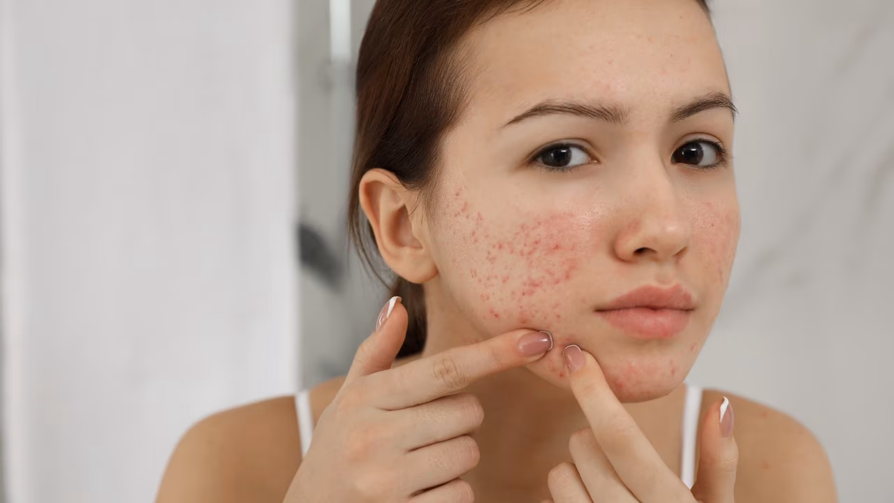 Persistent Acne Around The Same Time Each Month